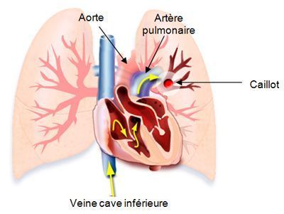 La thrombose la thrombose